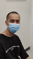 -大麦微针植发全国连锁