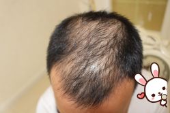 -大麦微针植发丨全国连锁