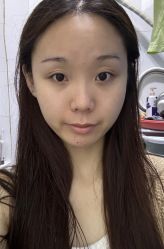 体验前-石家庄苏亚美联臣医疗美容医院