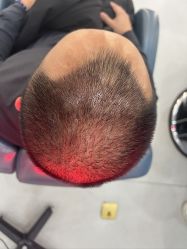 体验后-大麦微针植发全国连锁