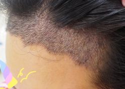 -大麦微针植发丨全国连锁