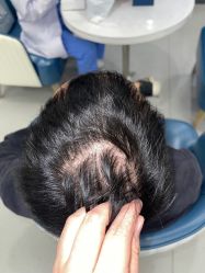 点击看大图 -大麦微针植发全国连锁