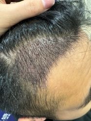 -碧莲盛·不剃发植发