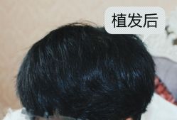 -大麦微针植发全国连锁