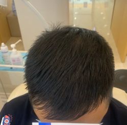 -大麦微针植发丨全国连锁