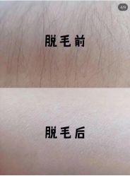 -薇兰专业脱毛连锁机构