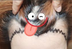 -大麦微针植发全国连锁