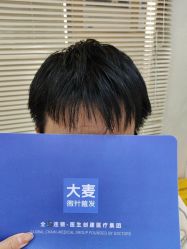 -大麦微针植发丨全国连锁