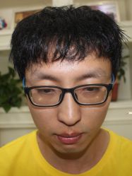 -大麦微针植发丨全国连锁