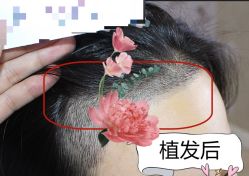 -大麦微针植发全国连锁