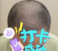 -大麦微针植发全国连锁