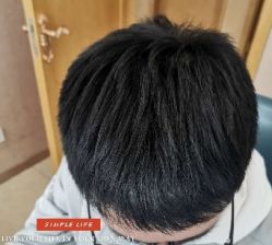 -大麦微针植发丨全国连锁