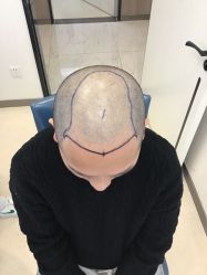 点击看大图 -大麦微针植发丨全国连锁