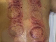 -莱蔻·圣灸堂·推拿艾灸(天山店)