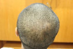 点击看大图 -大麦微针植发丨全国连锁