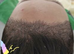 -大麦微针植发丨全国连锁