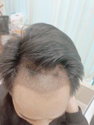 点击看大图 -碧莲盛·不剃发植发