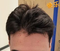 -大麦微针植发丨全国连锁