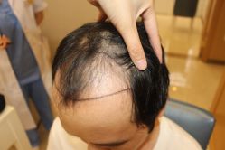 -大麦微针植发丨全国连锁