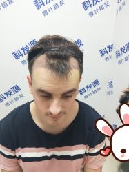 点击看大图 -大麦微针植发丨全国连锁
