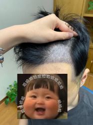 -大麦微针植发全国连锁