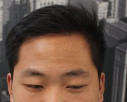 -大麦微针植发丨全国连锁