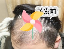 -大麦微针植发全国连锁