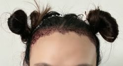 -大麦微针植发全国连锁