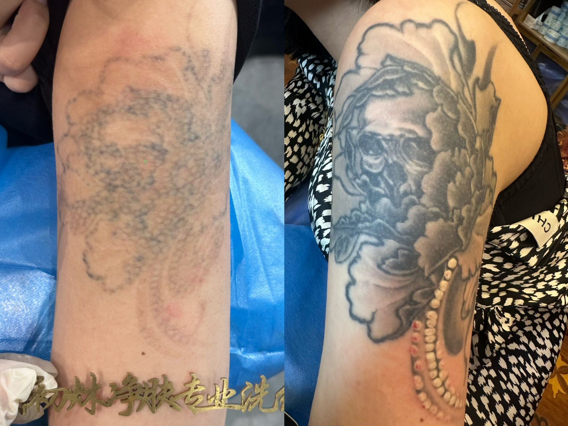 洗纹身两次对比