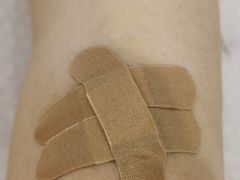 -杭州仁易堂中医康复医院疤痕修复