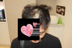 -大麦微针植发丨全国连锁