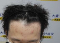 -大麦微针植发丨全国连锁