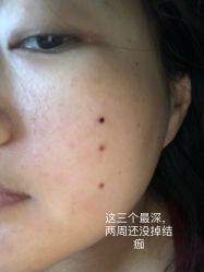 体验后-东剑医学美容·注射美学中心
