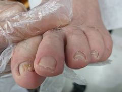 -新甲连锁甲沟炎灰指甲手足癣(中央大街店)