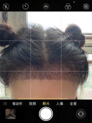 体验后-熙朵美学植发连锁