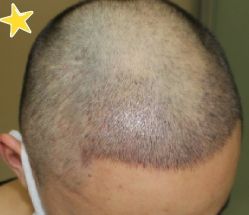 -大麦微针植发丨全国连锁