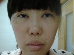 第七天，眼角拆线了，还是很猪头-上海华安整形外科门诊部