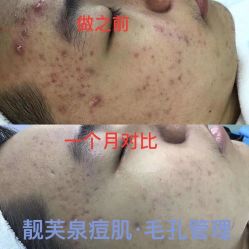 -靓芙泉祛痘.科技美肤连锁