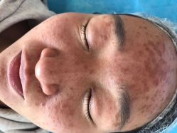 -美丽人生祛斑扁平疣汗管瘤中心
