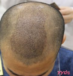 -大麦微针植发丨全国连锁