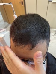 -大麦微针植发丨全国连锁