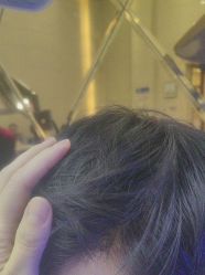 -碧莲盛·不剃发植发