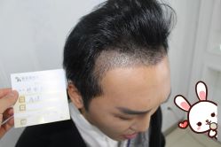 -大麦微针植发丨全国连锁