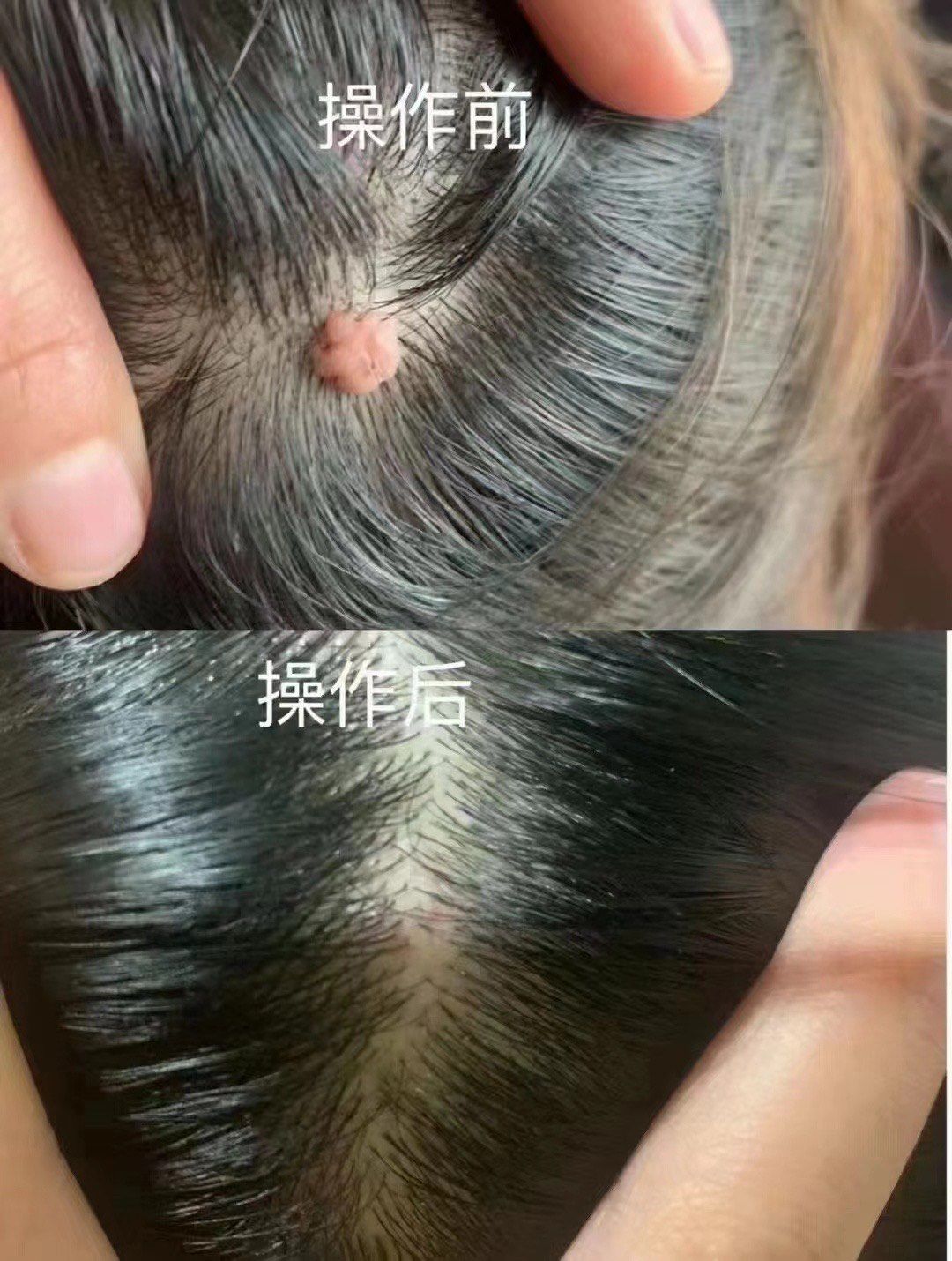 头顶肉瘊祛除效果对比,无痛即刻沾水不留痕#祛痣祛疣#黑痣肉痣#根深