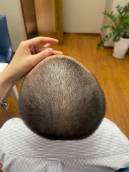 -大麦微针植发全国连锁