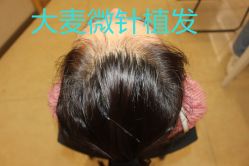 -大麦微针植发丨全国连锁