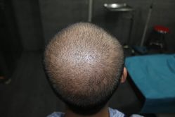 点击看大图 -大麦微针植发丨全国连锁