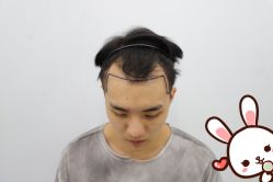 -大麦微针植发丨全国连锁