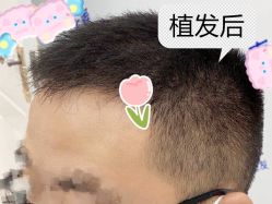 -大麦微针植发全国连锁