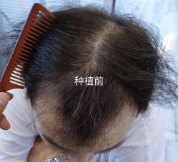 -牛大夫植发